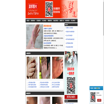 湿疹图片